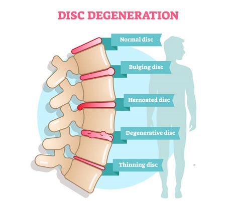 Degenerative Disc